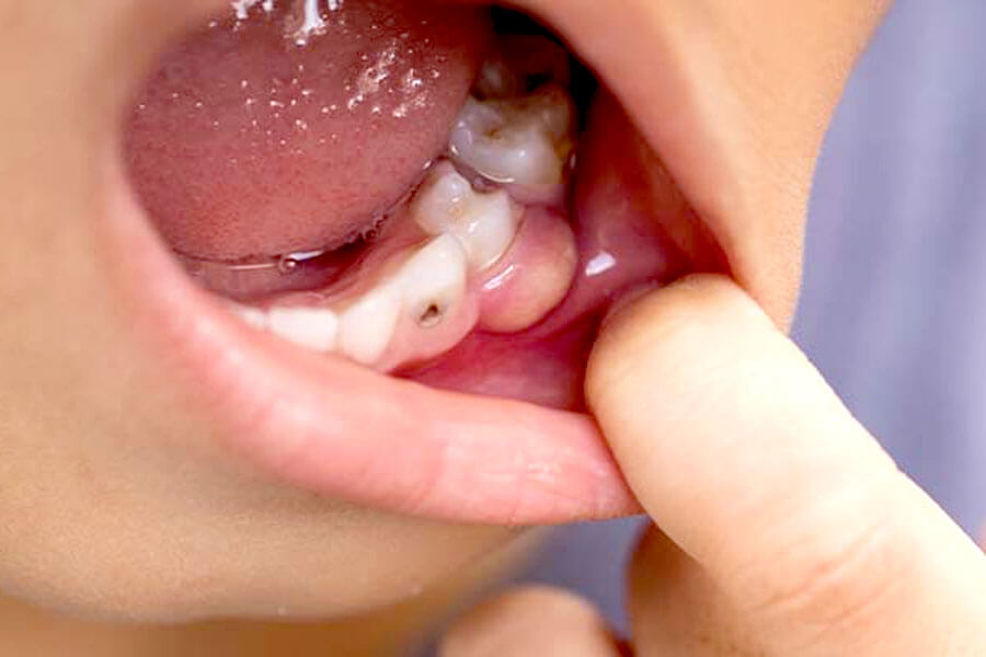 虫歯のみに反応する「う蝕探知機」