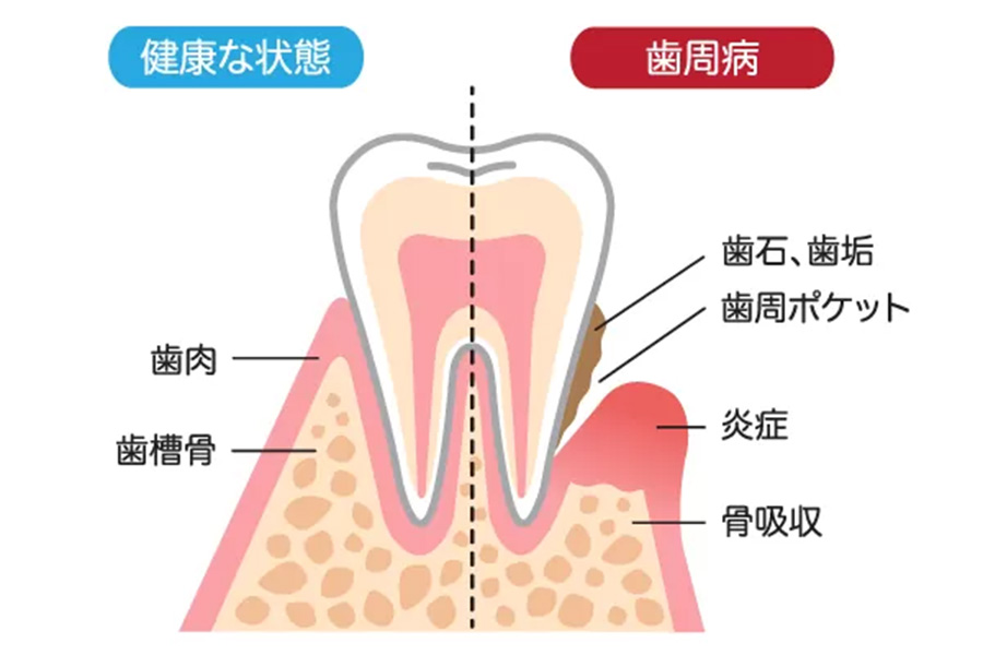 歯周病は歯を失う原因の第